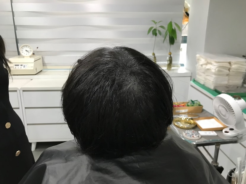 &lt;시술후_마른상태1&gt;