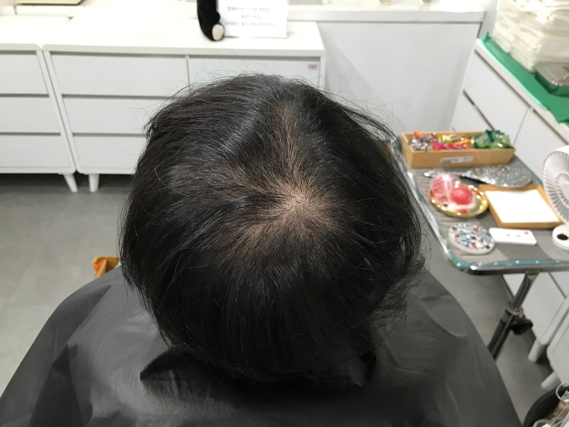 &lt;시술전_마른상태2&gt;