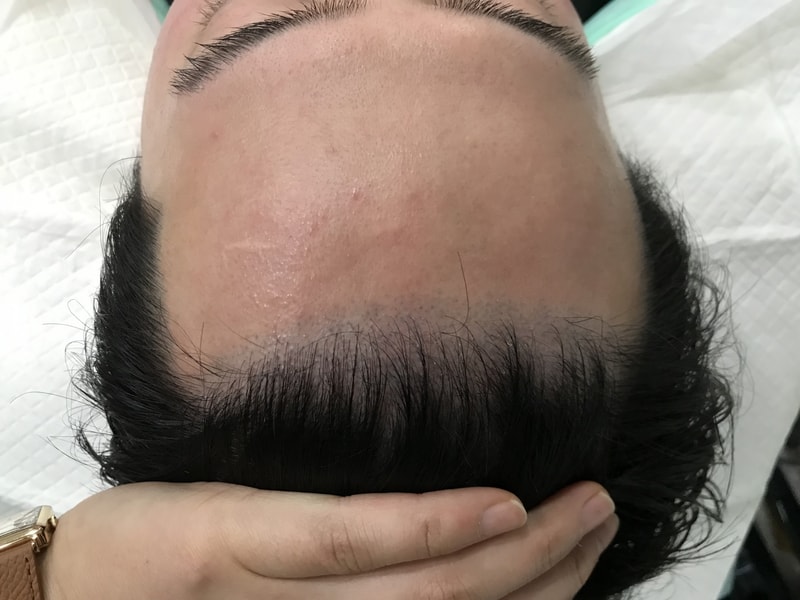 [延世美达人] 额头发际线~额头到头顶渐变圆点技法头皮纹身后期