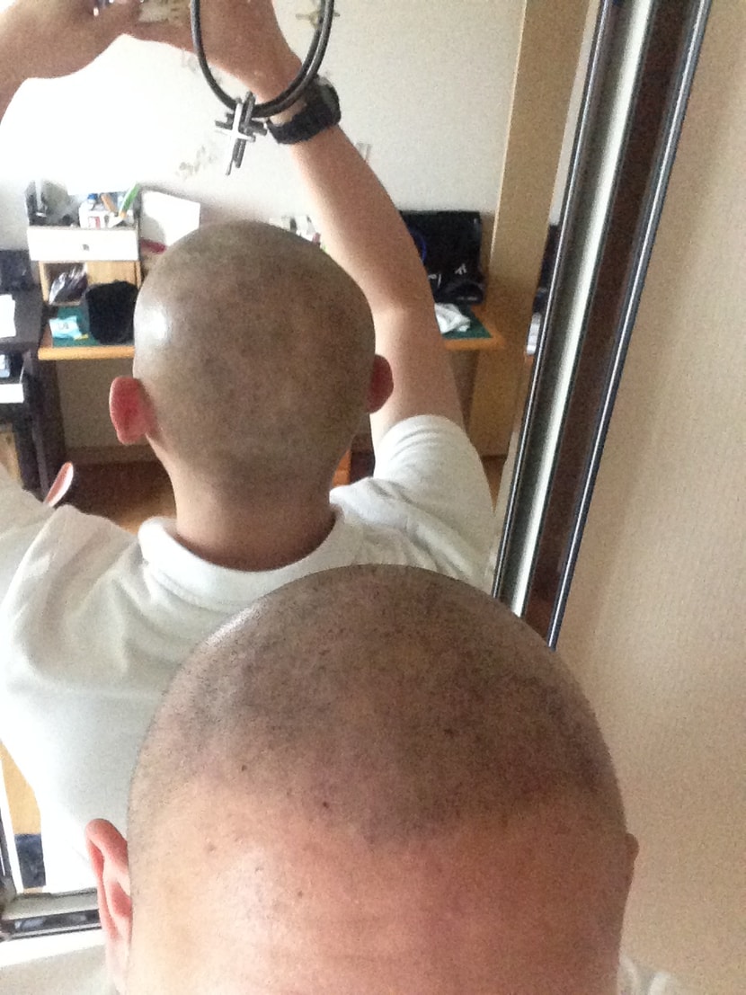 뒷머리 시술 후