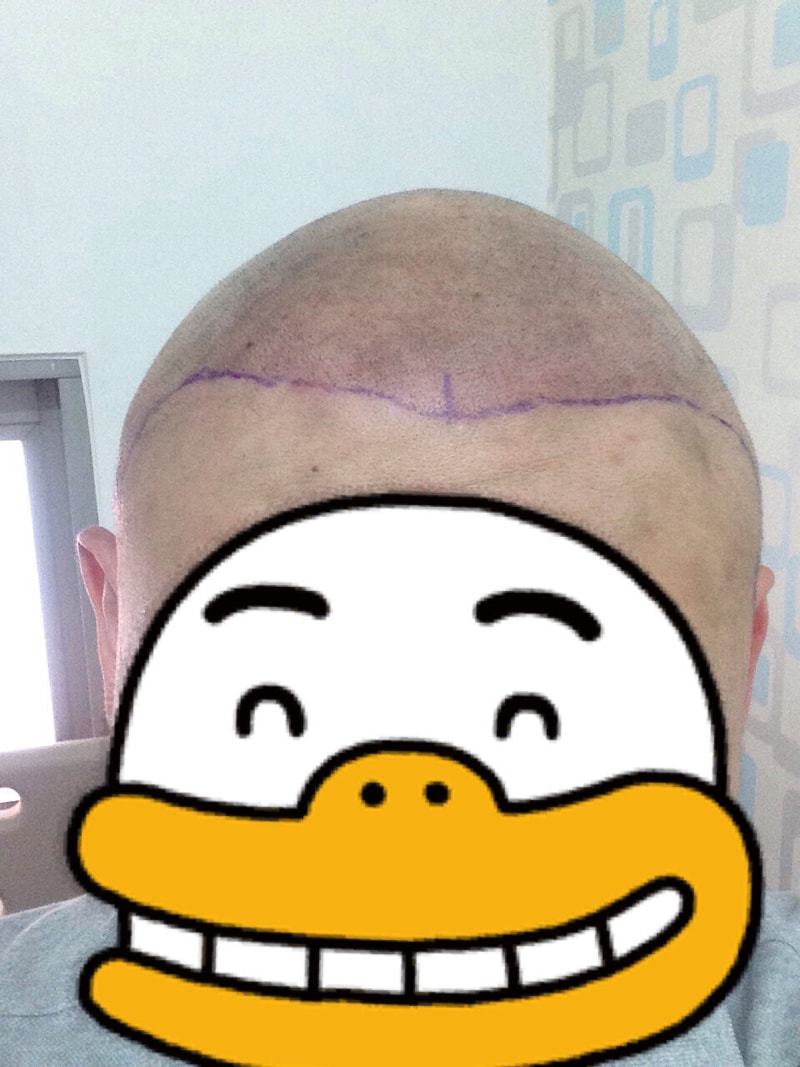 完全是光头皮纹身中间过程。