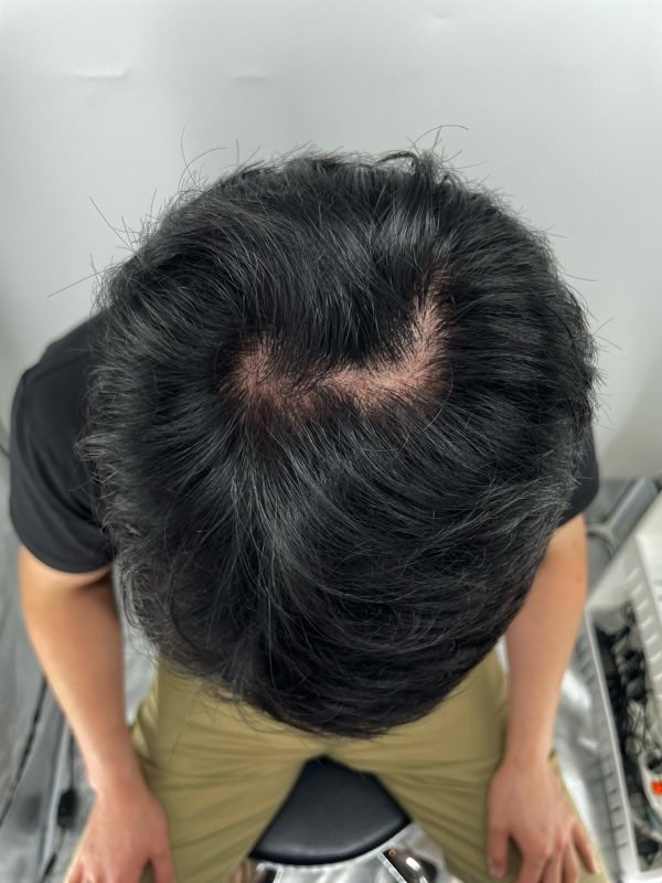 在江南站为了了解头皮纹身，在New Hair接受了手术。