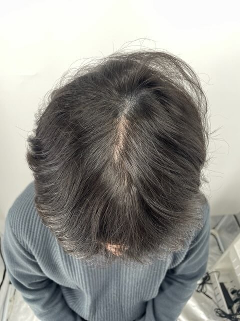 정수리 타투 가르마 문신 강남 뉴헤어 두피문신 후기 입니다^^ 정석은 뉴헤어
