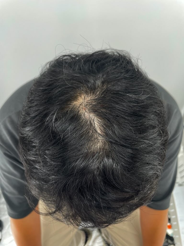 After the second round of scalp tattooing on the top of the head at Gangnam Station New Hair Plastic Surgery!