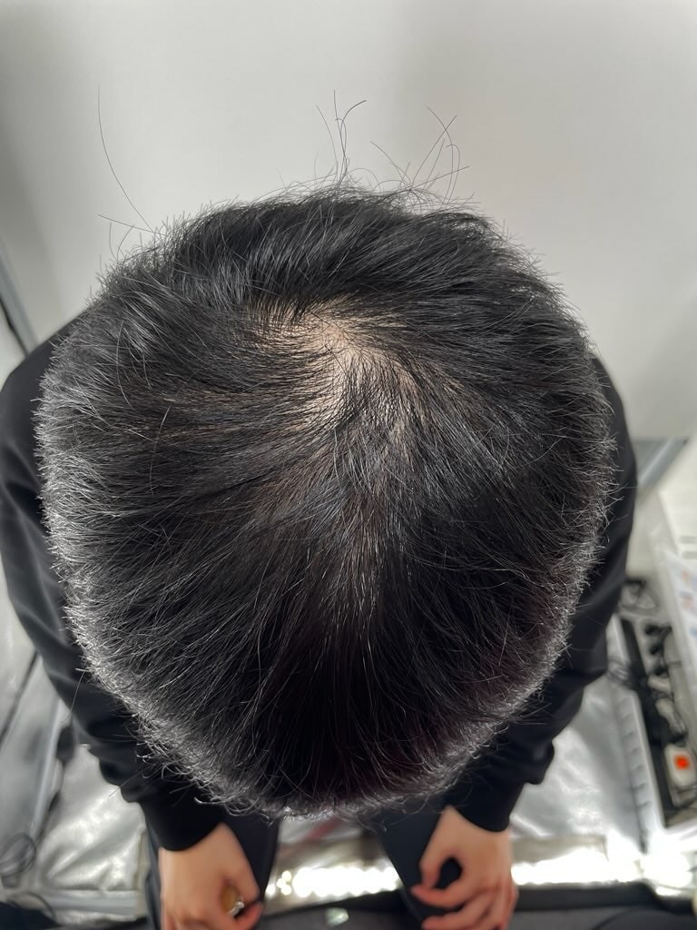 头顶发缝纹身NEWHAiR 植发中心收到的后记！ 头皮纹身是江南NEWHAiR 植发中心