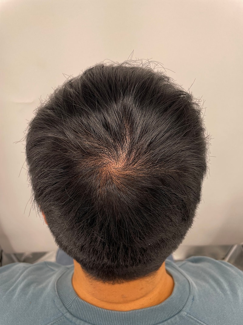 Top of the head tattoo! New Hair Hair Plastic Surgery Clinic in Gangnam after scalp tattoo :) I'm satisfied