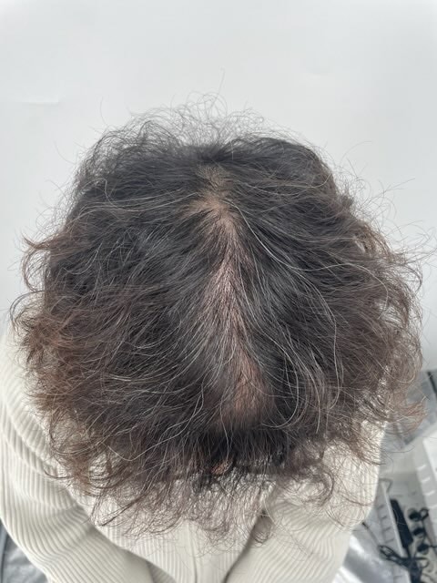 완전체가 된 3회차 후기 (강남 뉴헤어 두피문신 후기)