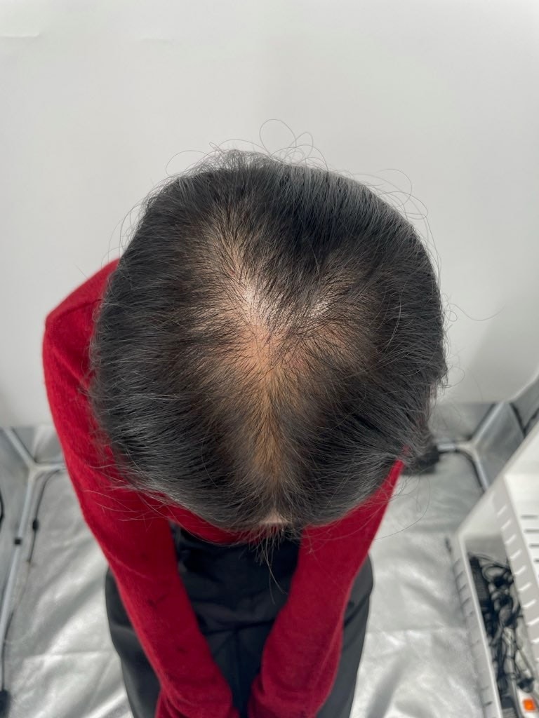강남 뉴헤어에서 두피문신 마무리했습니다