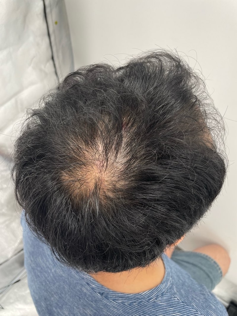 江南新发头皮纹身后期