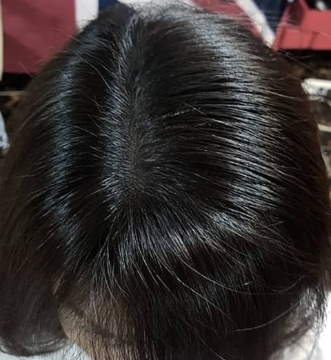 두피문신후