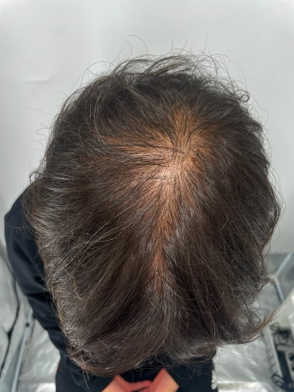 만족스러운 두피문신 정수리전체 두피문신 했습니다! 강남 뉴헤어 감사합니다