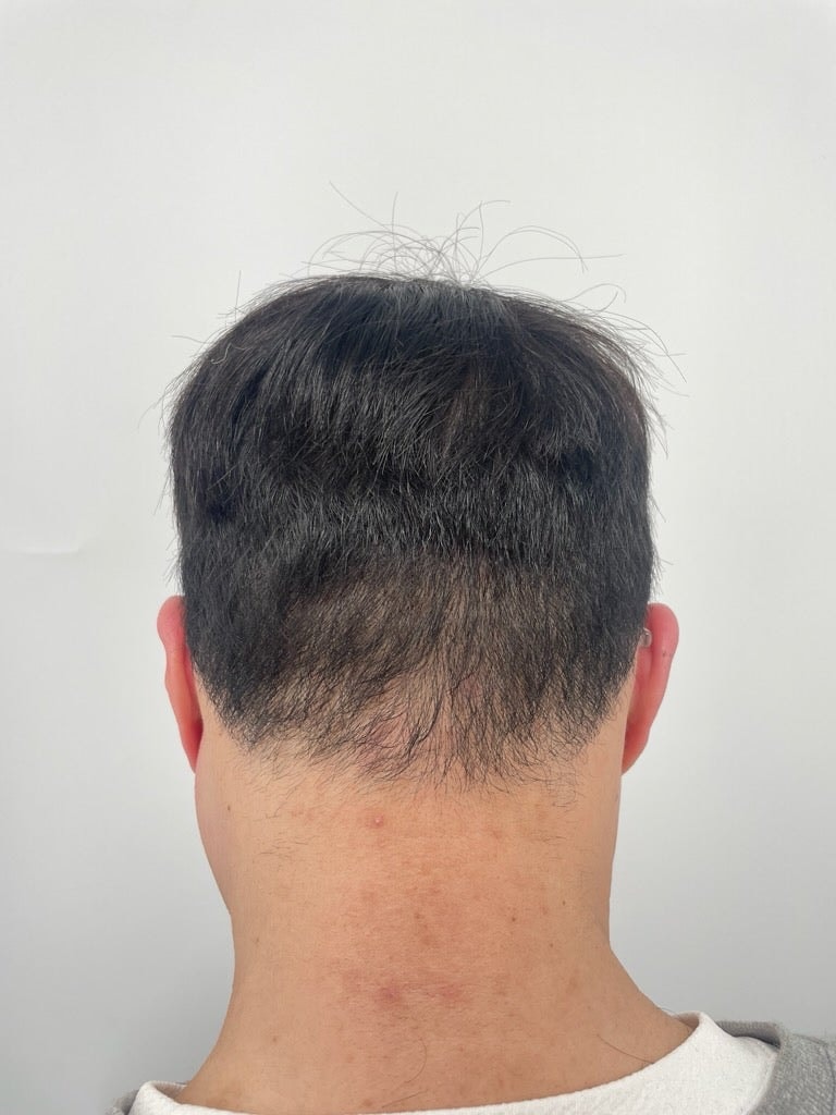 휑한 구레나룻이랑 뒤통수 두피문신 2차까지 받았습니다! 강남?두피문신은 뉴헤어에서