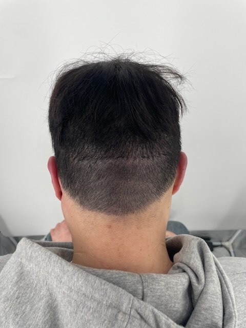 시술 후