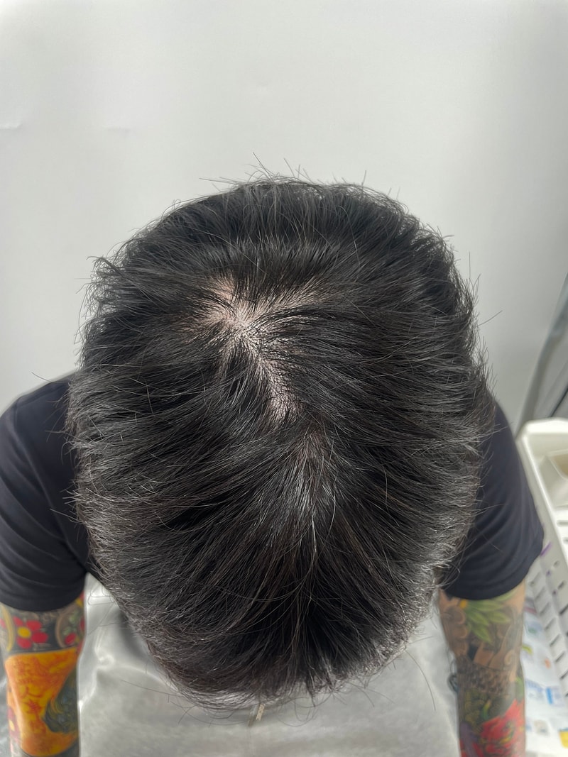 강남에서 두피문신 받으세요! 특히 뉴헤어모발성형외과가 잘합니다 인증