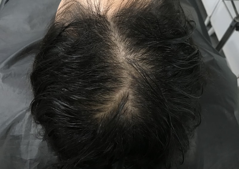 头皮纹身后期
