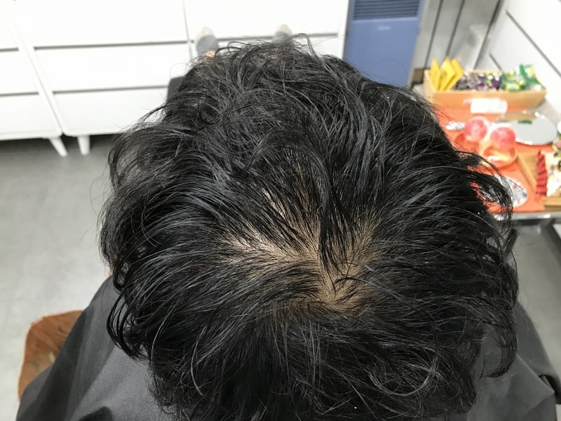 두피문신 1차 시술 후기(수지침미세도트)