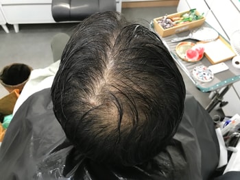 시술 전