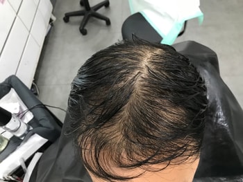 시술 전