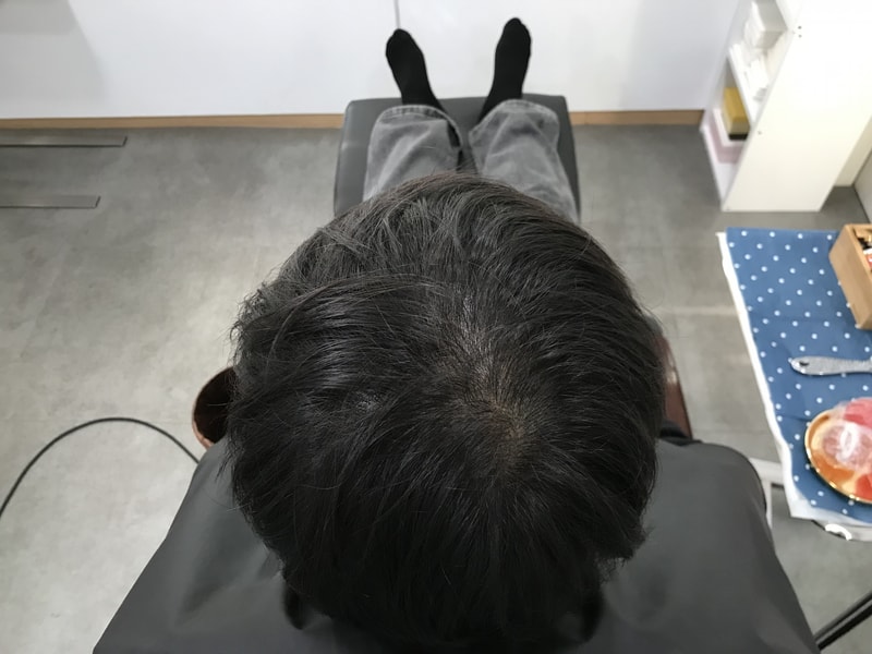 延世ミダイン医院で2次頭皮タトゥーを入れた体験談を投稿します~~~