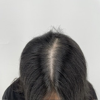 江南ニューヘア頭皮タトゥーの2次体験談