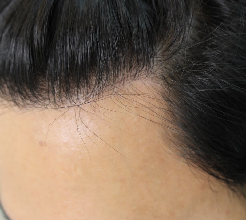The scalp tattoo is really effective