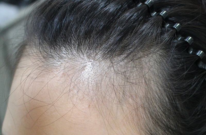 My sister got scalp tattoos with me