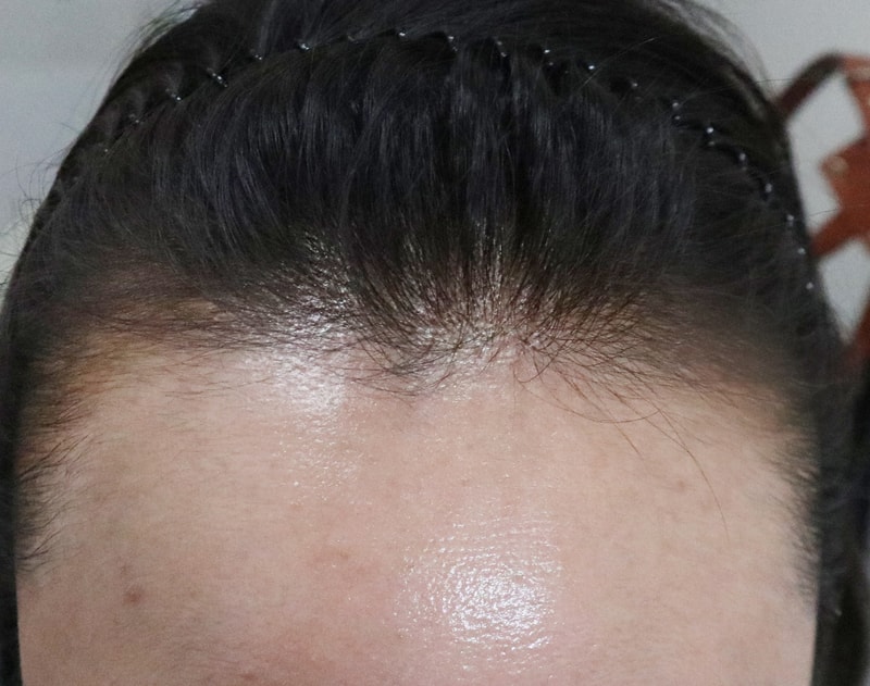 I got an M-shaped scalp tattoo