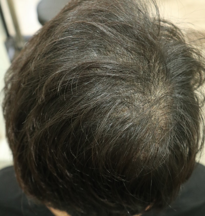 I got a scalp tattoo from the Hanna Yves Hair Transplantation Center