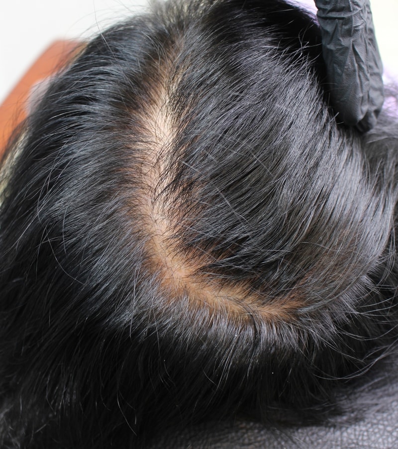 I got a scalp tattoo for my mom's hair