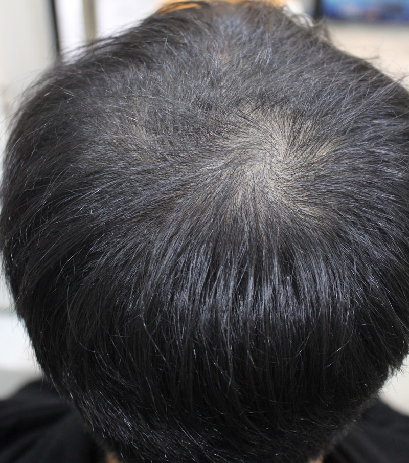I'm satisfied with the scalp tattoo on the top of my head