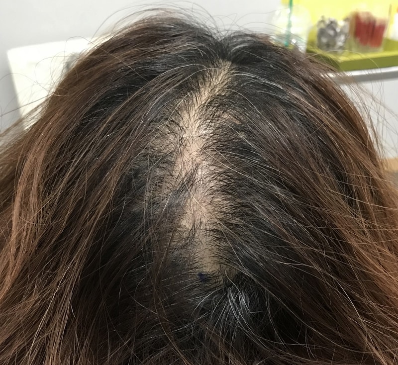 这是女子头顶发缝头皮纹身第一次后记