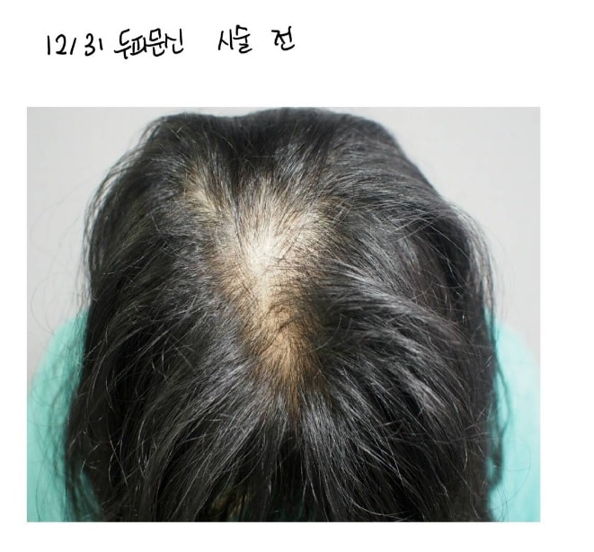 두피 문신 전