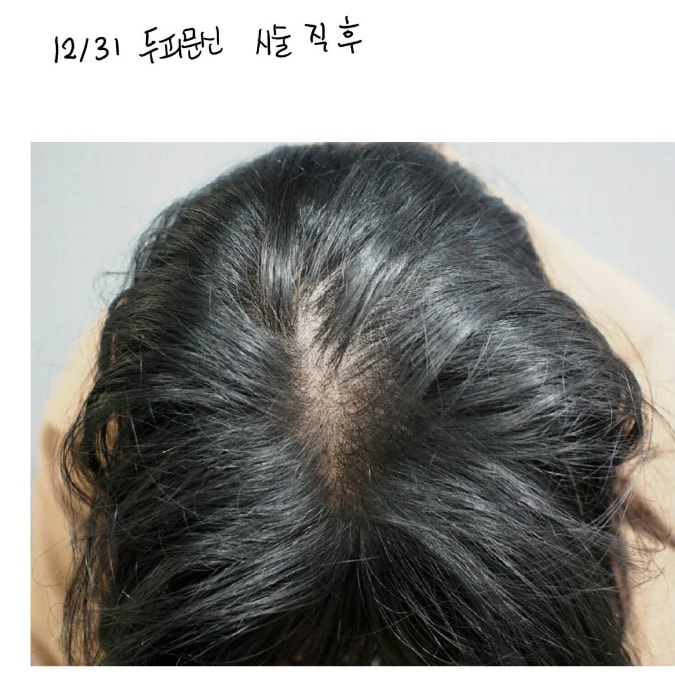 두피 문신 후