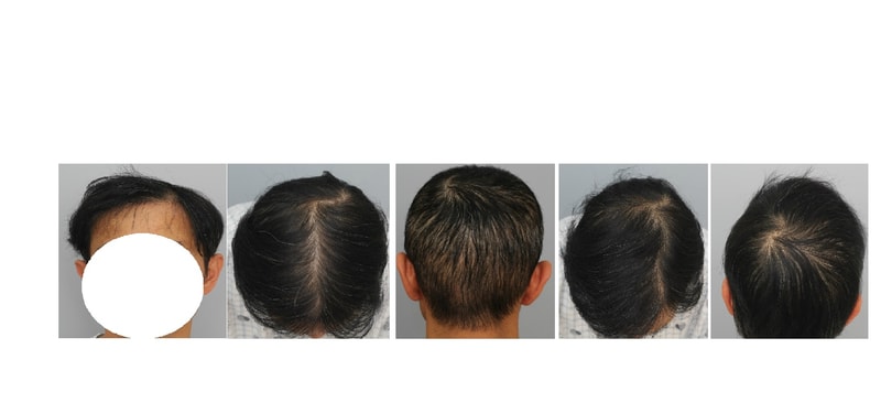 티가 나는 제 두피문신.