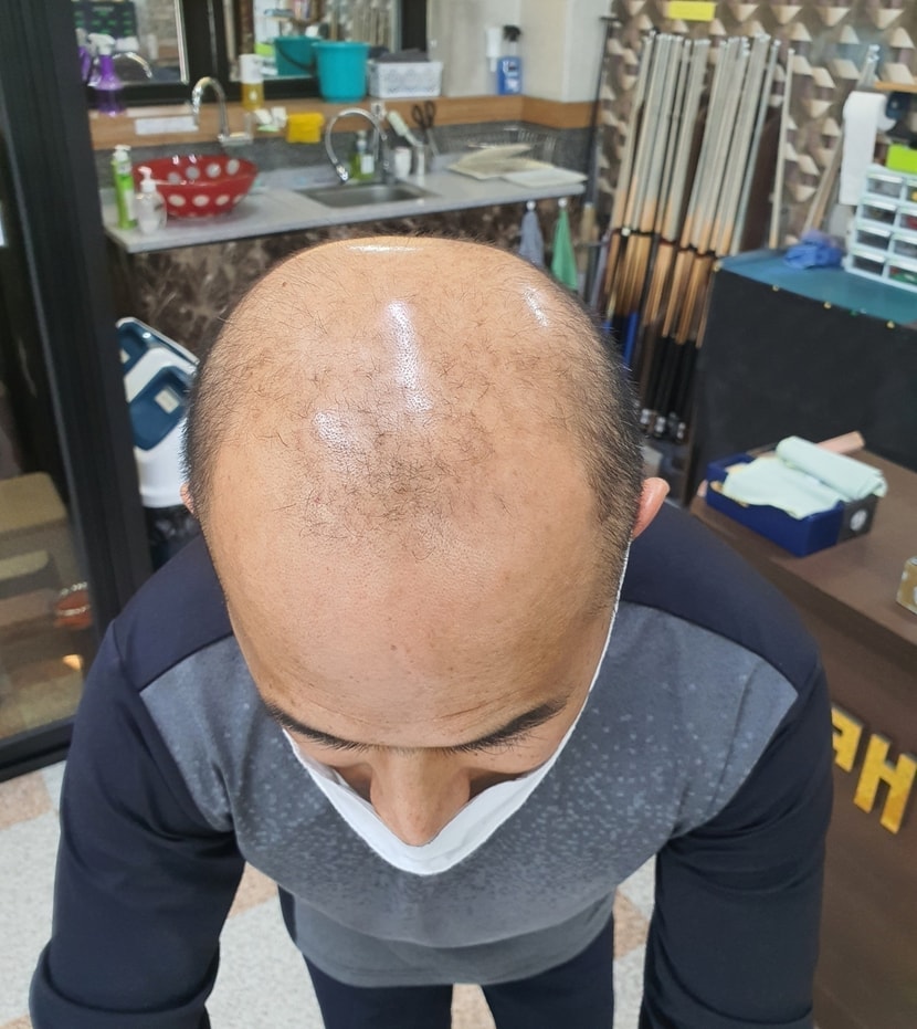 시술전 사진입니다.