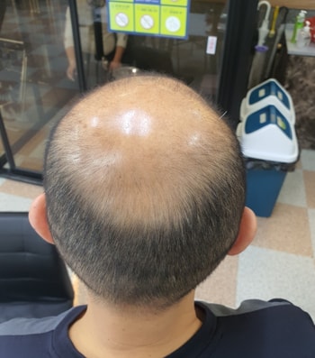 시술전 뒤통수 모습입니다. 