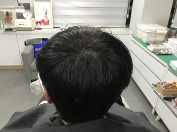 시술후