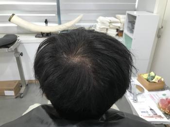 시술전