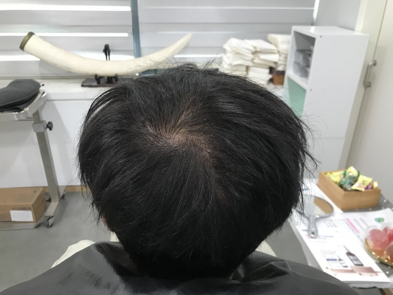 在'延世美达人'里纹了头皮