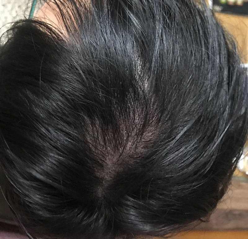 这是头皮纹身第一次后记。