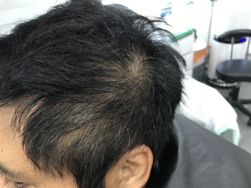 頭皮タトゥー後記