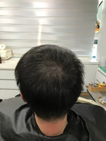 두피문신 1차후입니다. 