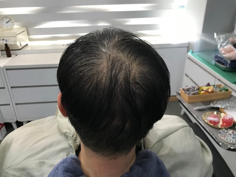 这是延世美达人头皮纹身第一次后记。