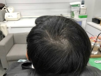 2차 시술 전-1