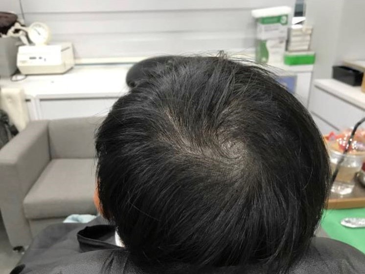 2019.04.10 头顶头皮纹身 2次