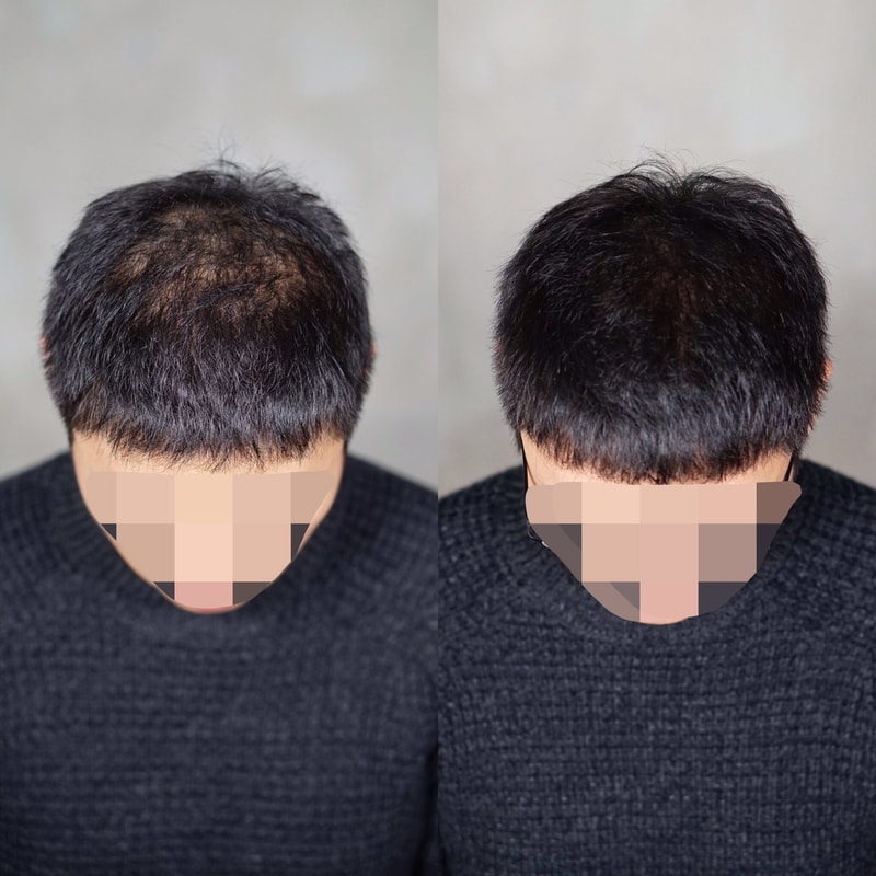 是头皮纹身后记。[纹身店]