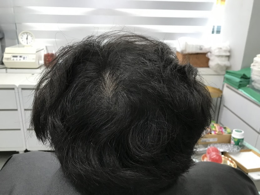 리터치 전 머리2