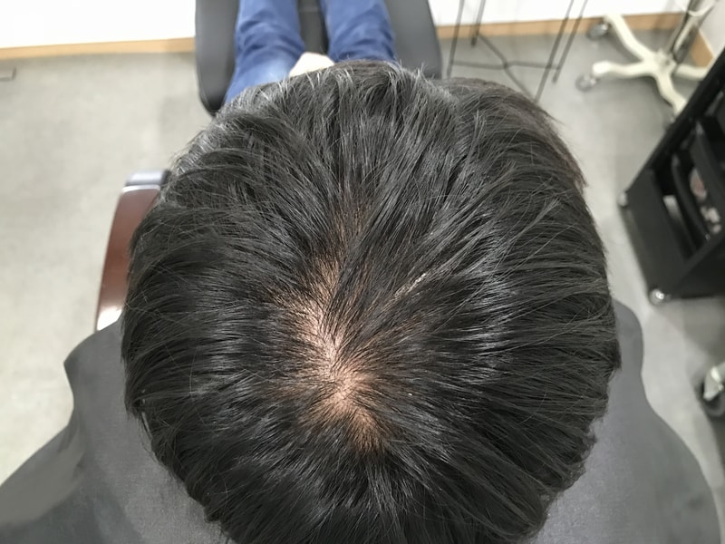 头皮纹身第一次后期