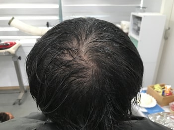 시술 전 젖은 머리
