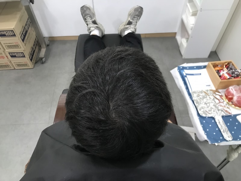 頭皮タトゥー 1回目のリタッチ体験談